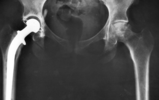 HIp replacement