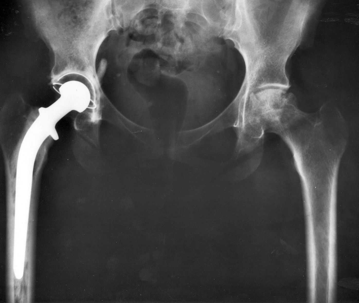 icd 10 code for hip replacement left