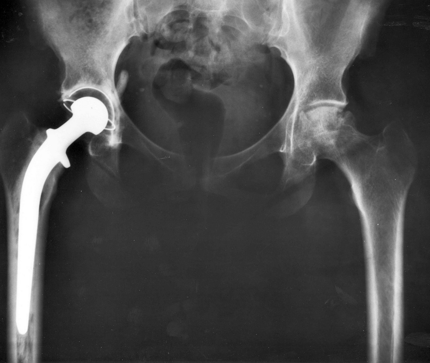 Have You Had A Hip Replacement Recently Keith Williams Law Group